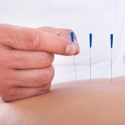 طب سوزنی در کرج